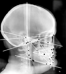 analyse céphalométrique pour déterminer la bonne posture